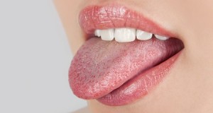 langue blanche remede et causes