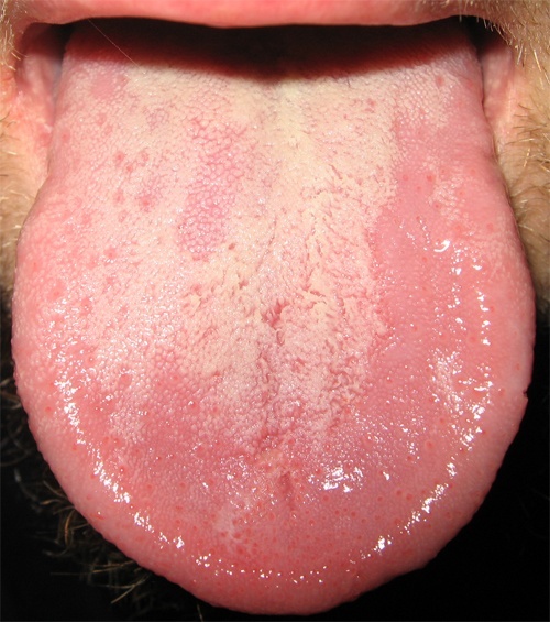 langue blanche mauvaise haleine